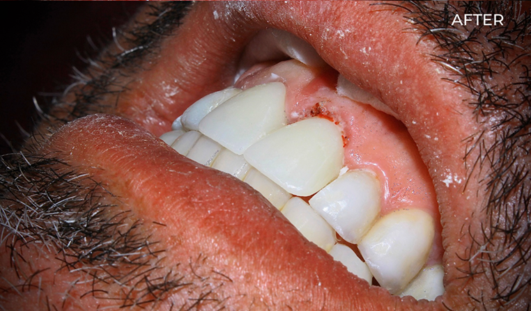 After treatment Bali Dental Assistance