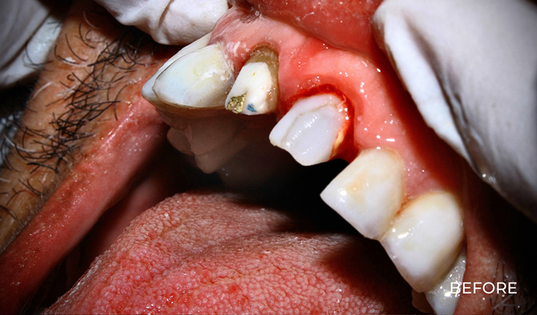 Before treatment Bali Dental Assistance
