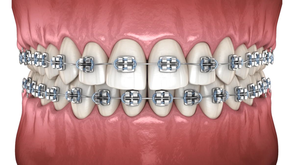 Dental Braces Preview in Human HD