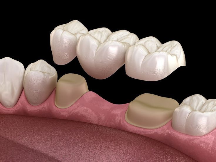 Dental Bridge Preview in Human HD