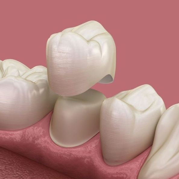 Dental Crown Preview in Human HD