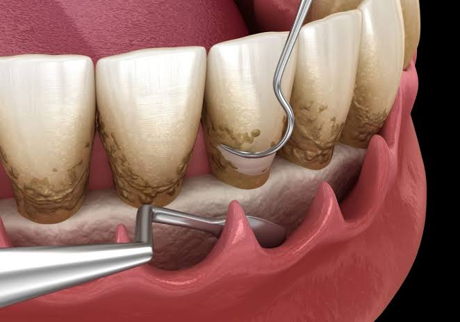 Dental Curretage Preview in Human HD