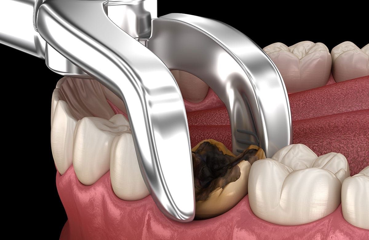 Dental Extraction Preview in Human HD