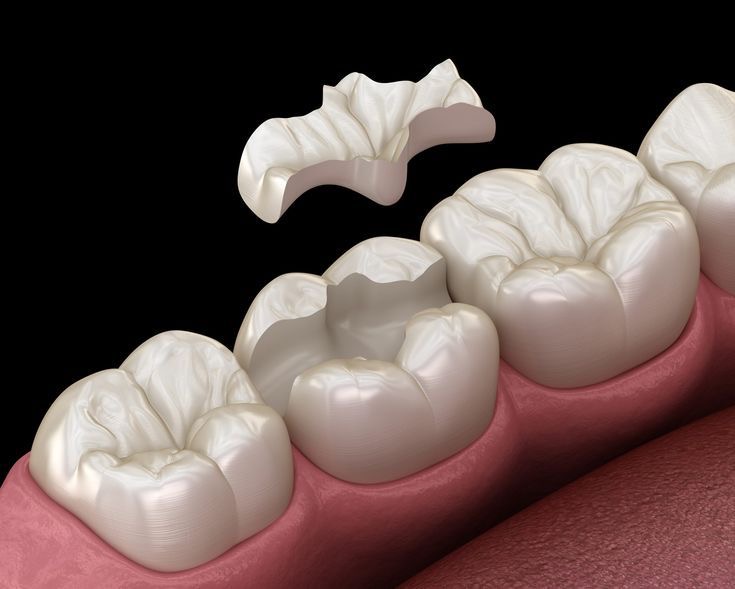 Dental Inlays on Lays Preview in Human HD