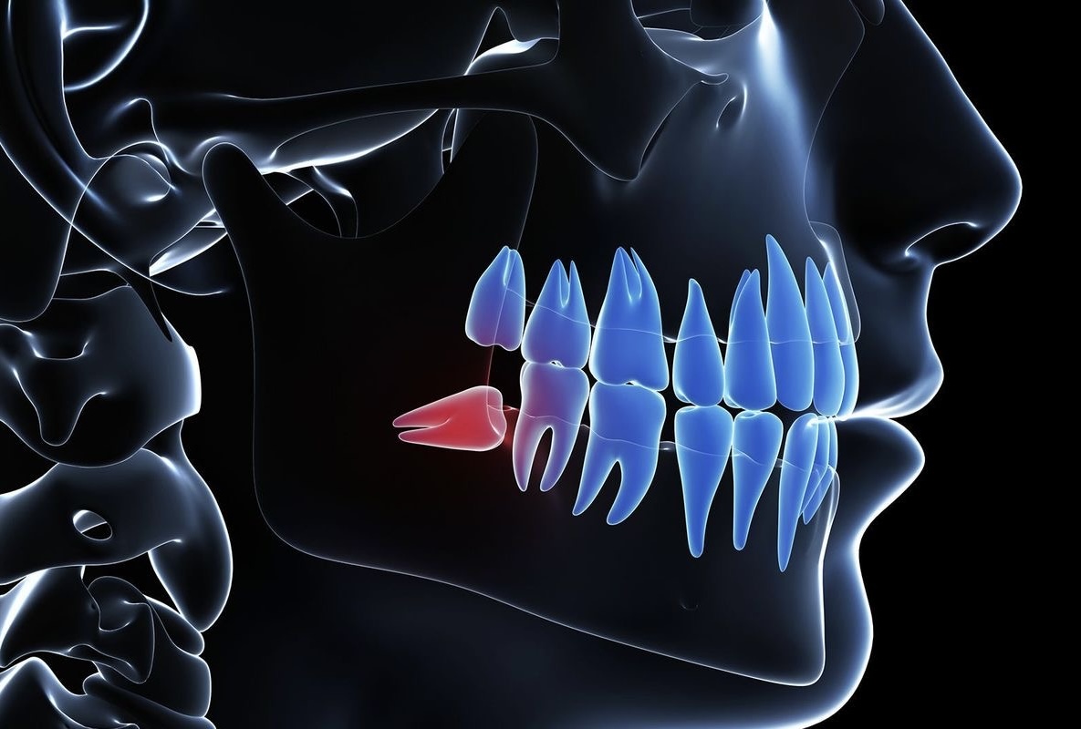 Dental Odontectomy Preview in Human HD