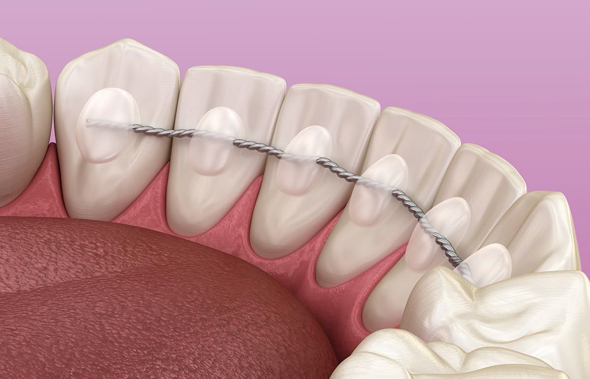 Dental Retainer Preview in Human HD