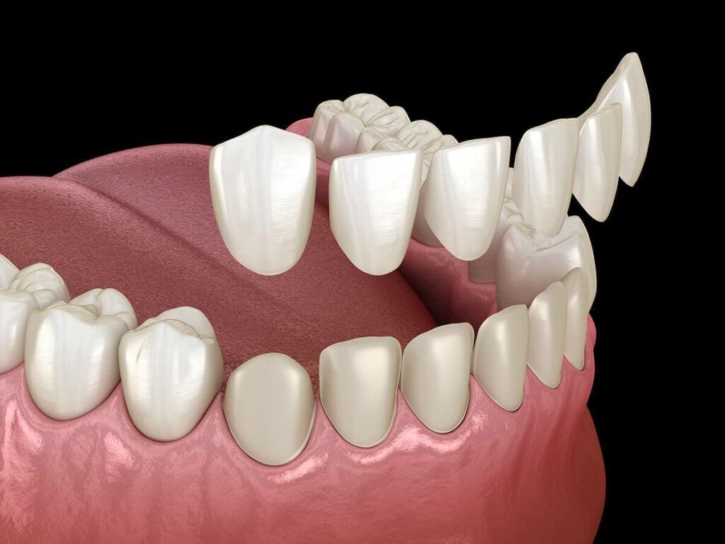 Dental Veneer Preview in Human HD