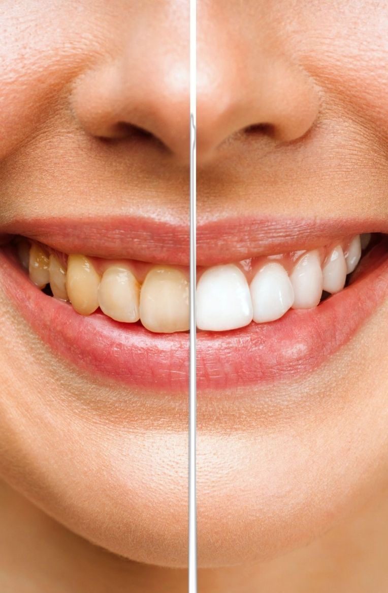 Dental Whitening Preview in Human HD