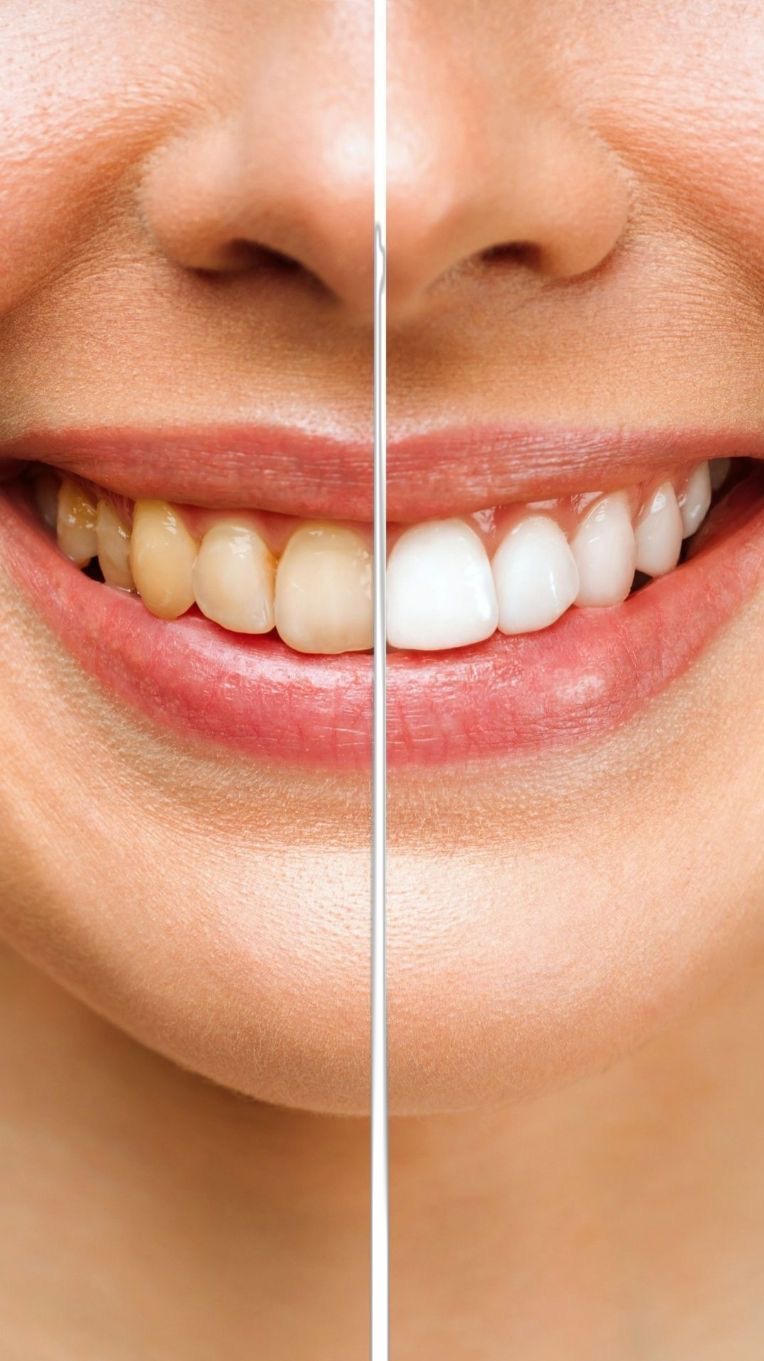 Dental Whitening