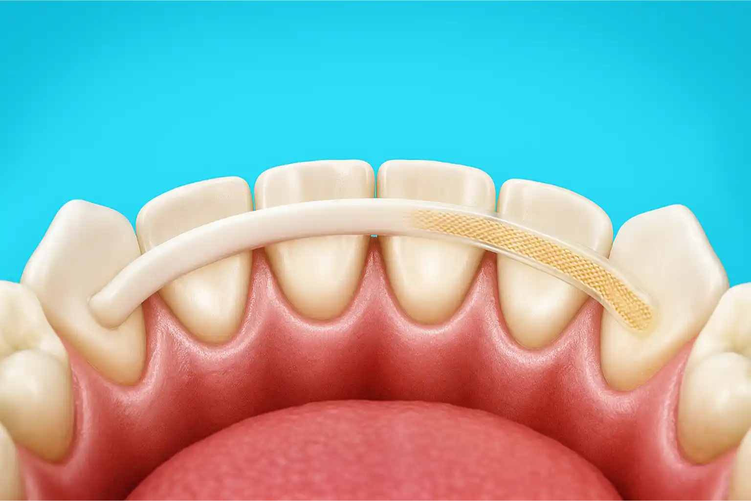 Dental Splinting Preview in Human HD